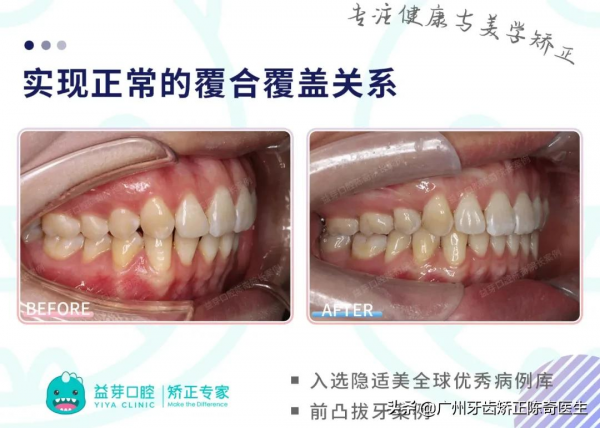 全球優秀案例 | 隱適美拔牙矯正1年半時間解除牙列間隙、改善嘴凸 全球優秀案例 | 隱適美拔牙矯正1年半時間解除牙列間隙、改善嘴凸