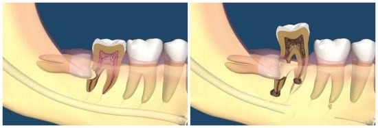 智齒到底要不要拔?有關“智齒”的問題,答案統統在這裡 智齒到底要不要拔?有關“智齒”的問題,答案統統在這裡