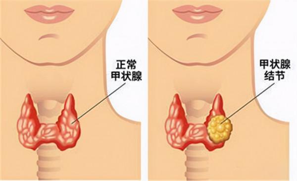 35歲女子，甲狀腺結節轉癌，醫生惋惜：身體早提醒，是她沒在意