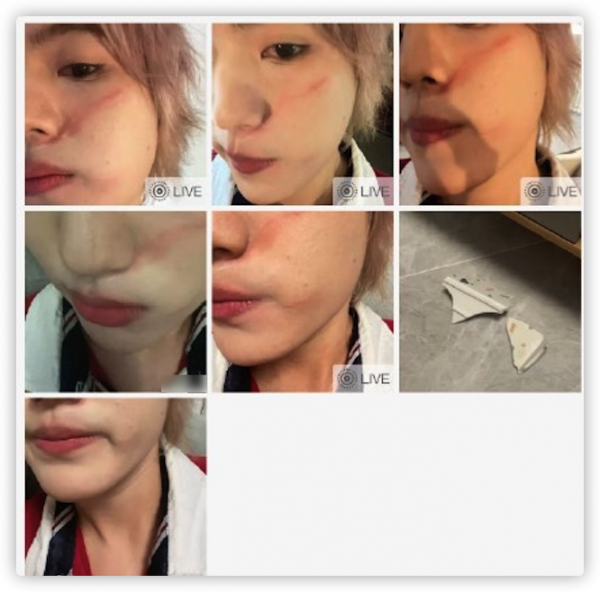 25歲男星被指控打人！直接拿碗砸向好友，受害者臉上傷痕令人後怕