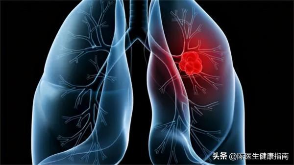 35歲陳先生不抽菸不喝酒,為什麼就患了肺癌呢?看看醫生怎麼說 35歲陳先生不抽菸不喝酒,為什麼就患了肺癌呢?看看醫生怎麼說