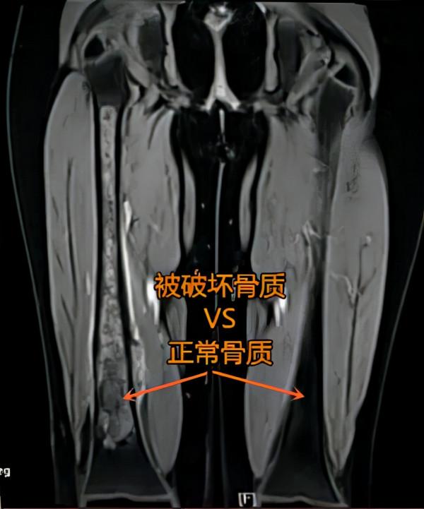 10歲女孩大腿疼一年多,醫生建議從大腿根處截肢 10歲女孩大腿疼一年多,醫生建議從大腿根處截肢