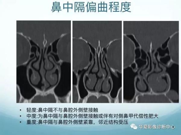 頭頸五官CT斷層解剖圖及常見病影像診斷