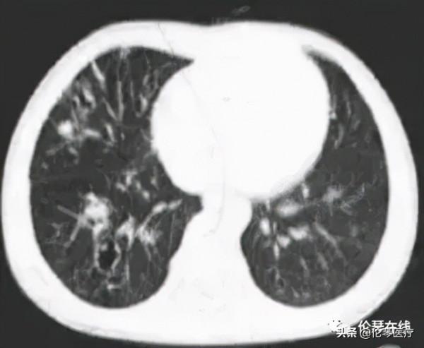 這種吃螃蟹吃出的怪病,影像醫生都是怎麼診斷的?|倫琴醫療 這種吃螃蟹吃出的怪病,影像醫生都是怎麼診斷的?|倫琴醫療