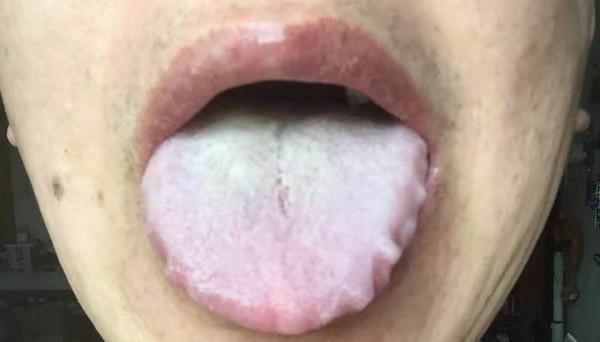 如何辨別寒溼和溼熱?看本文案例分析 如何辨別寒溼和溼熱?看本文案例分析