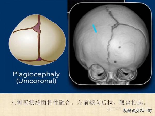 小兒顱縫早閉的診斷治療