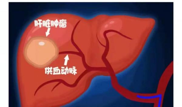 《揭秘肝癌介入治療》