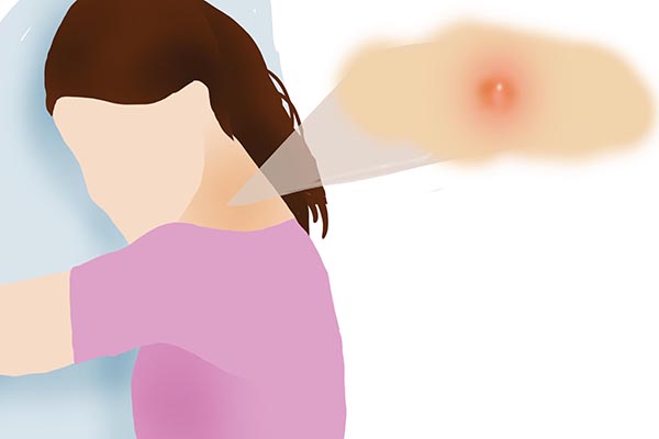 身上長出的“小揪揪”,到底是面板病,還是HPV感染? 身上長出的“小揪揪”,到底是面板病,還是HPV感染?