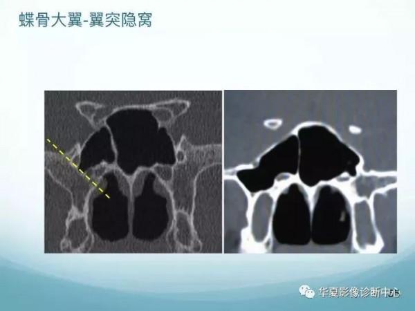 頭頸五官CT斷層解剖圖及常見病影像診斷