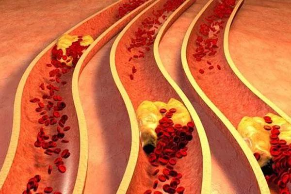 3箇中成藥，活血化瘀，軟化血管，化解斑塊，防治血管病變