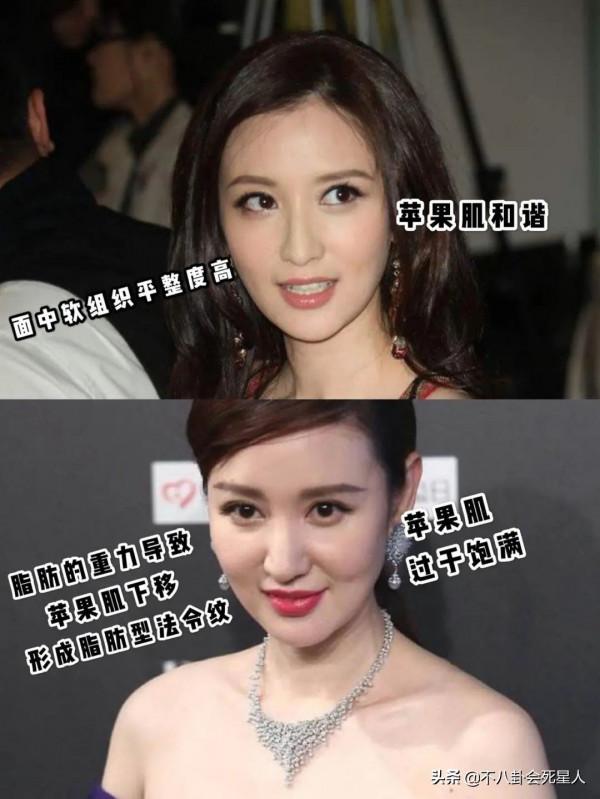 中年女星整容後遺症一堆！臉像鞋拔子，不敢做大表情，演戲沒法看