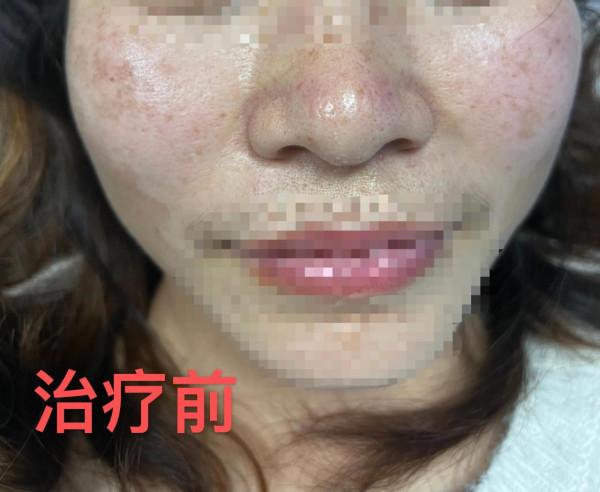 黃褐斑、失眠調理一次案例