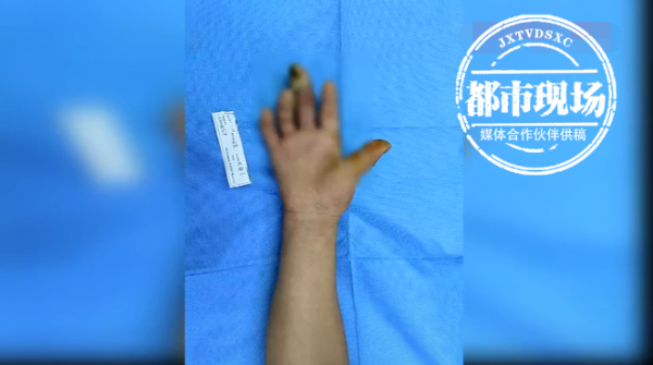 男子木刺扎手不重視，拖延2個月後半段中指被切除