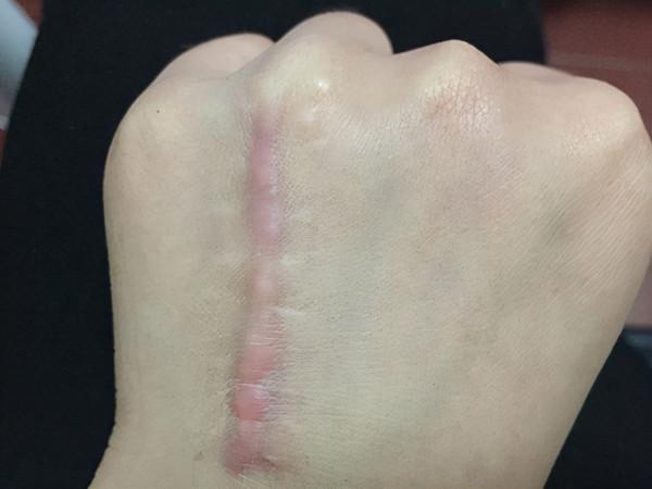 疤痕多久就過了增生期? 疤痕多久就過了增生期?