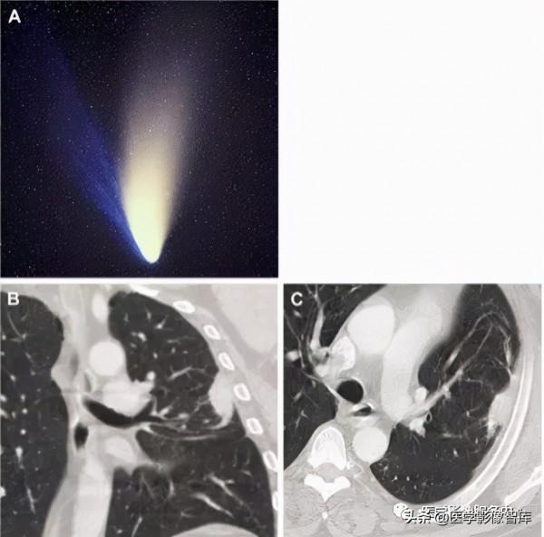 22個肺部疾病的CT徵象 22個肺部疾病的CT徵象
