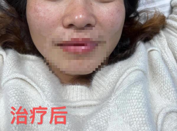 黃褐斑、失眠調理一次案例