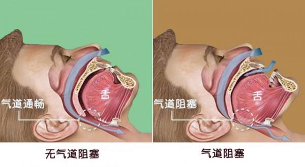 發現“反勺型”的高血壓,一定不要放過這個繼發性高血壓的病因 發現“反勺型”的高血壓,一定不要放過這個繼發性高血壓的病因