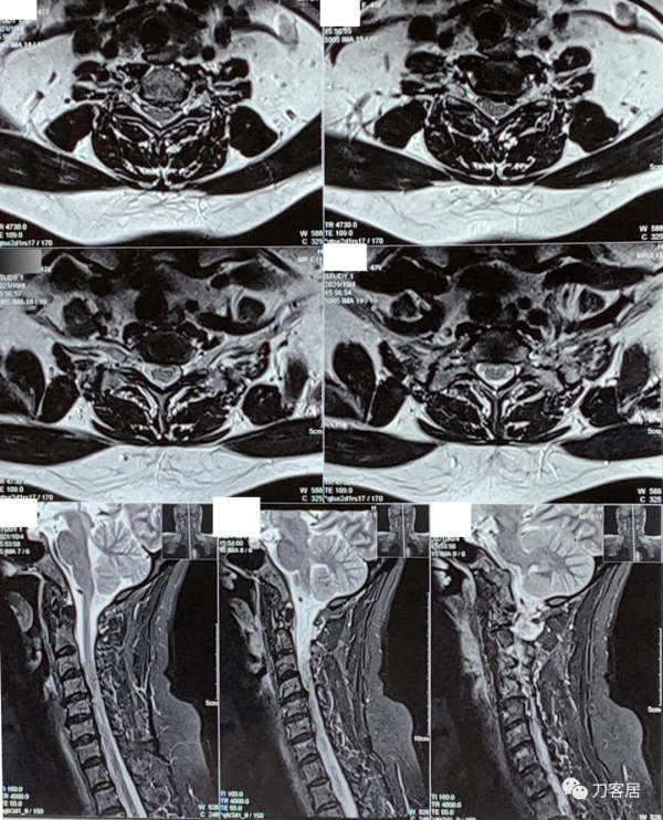 查體的重要性，一直按照腰椎間盤突出症治療的脊髓型頸椎病