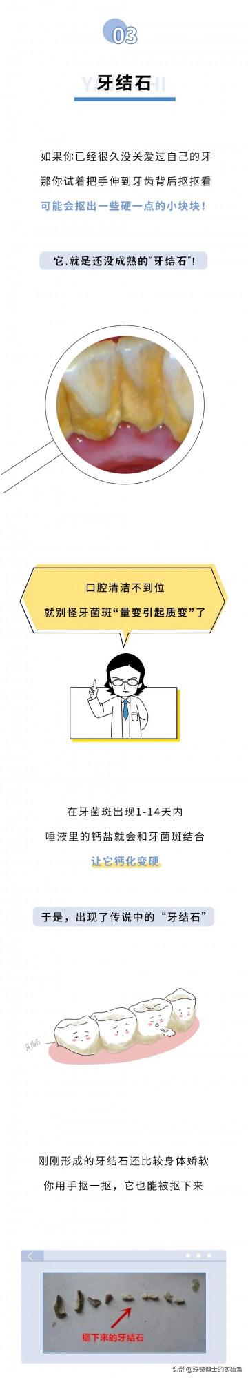 牙縫裡摳出的黃色物質到底是啥?為啥那麼臭 牙縫裡摳出的黃色物質到底是啥?為啥那麼臭