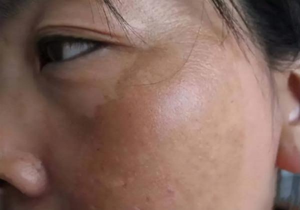 45歲女子祛斑半年,黃褐斑從有到無,經驗分享:4件事或是關鍵 45歲女子祛斑半年,黃褐斑從有到無,經驗分享:4件事或是關鍵