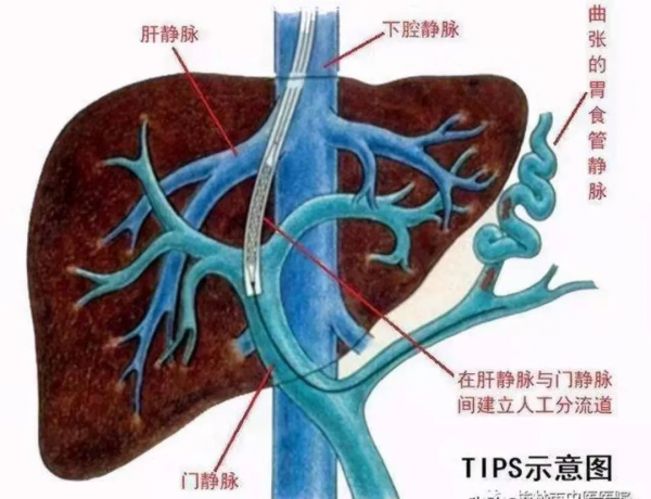 我院胸外科消化介入治療組董劍群團隊成功獨立完成我市首例TIPSS手術【技術新突破】 我院胸外科消化介入治療組董劍群團隊成功獨立完成我市首例TIPSS手術【技術新突破】