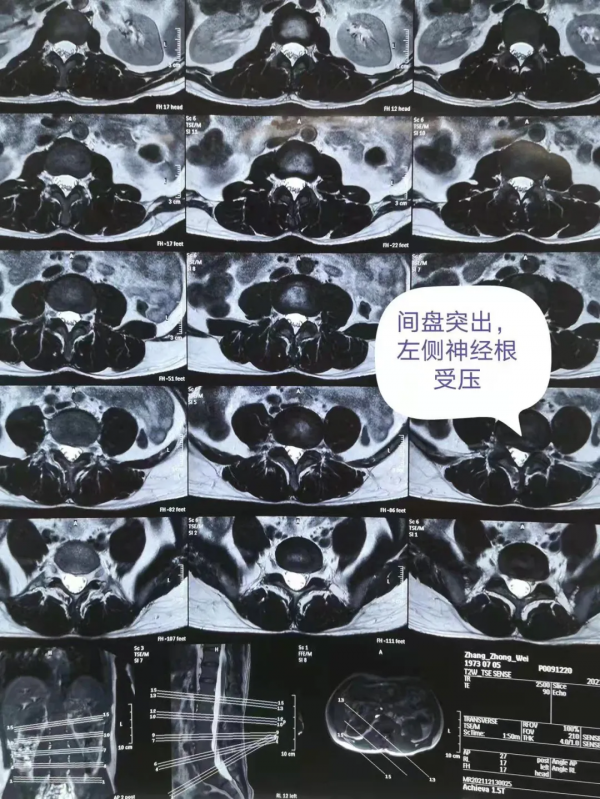 妙手除病痛，德高暖人心——骨科成功救治腰椎間盤突出重疾患者