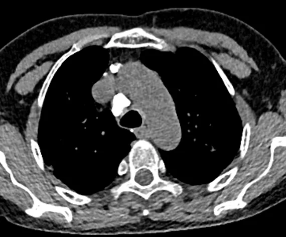 咳嗽一年找不到原因，原來是鈣化惹的禍