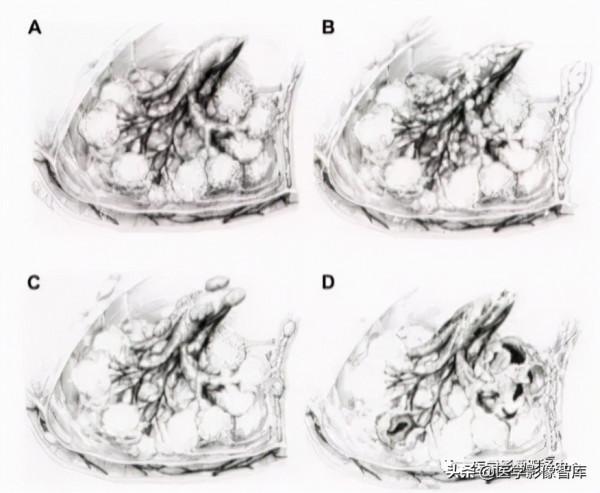 22個肺部疾病的CT徵象 22個肺部疾病的CT徵象