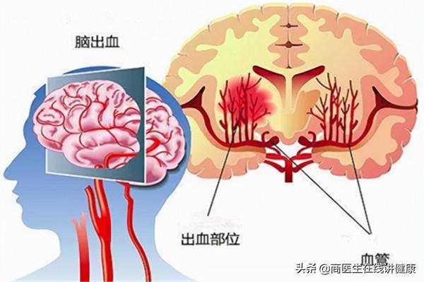 有高血壓的人要注意了，醫生：出現這3種狀況當心腦出血，要警惕