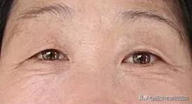 #安心變美課堂##我的安心變美推薦# 眼皮越來越松，怎麼辦？