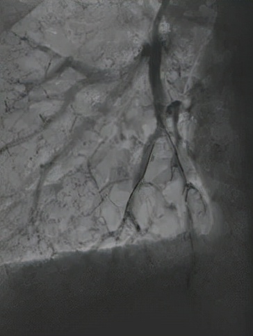 一個腸息肉切除小手術,發現更大致命“隱患” 一個腸息肉切除小手術,發現更大致命“隱患”