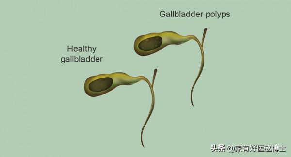 最常見5類息肉每個人都可能有，哪些無癌變風險，哪些需要切除？