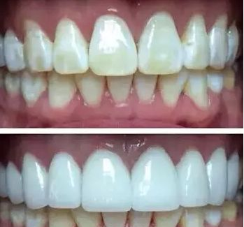 氟斑牙治不好？老牙醫：這幾個方法可以改善