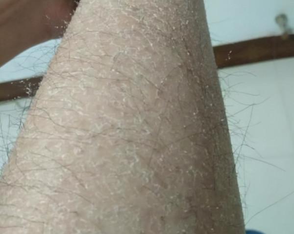 秋冬季節，每次脫褲子，腿上的白色皮屑是怎麼回事兒？