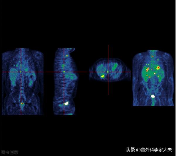 直腸癌吻合口漏發生的術中危險因素到底有哪些？