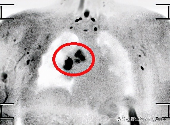 健身預防癌症嗎? 健身預防癌症嗎?