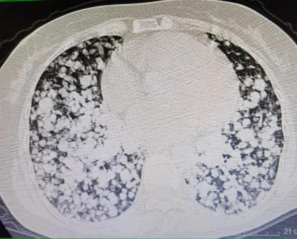 天啊！這個肺千瘡百孔，到底怎麼了？原來是肺轉移癌