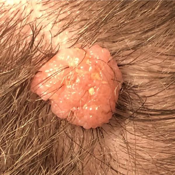 頭皮腫物（皮內痣）