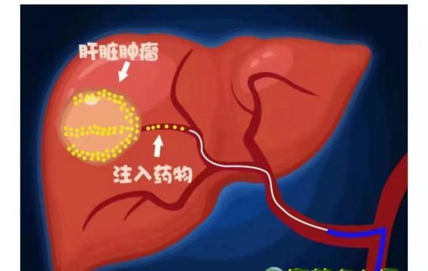 《揭秘肝癌介入治療》