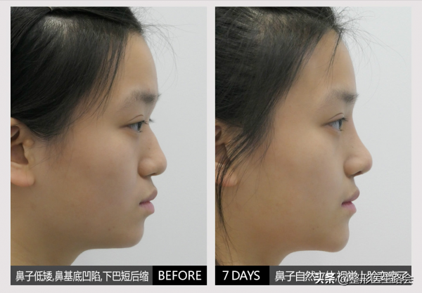 做假體隆鼻,整形醫生告訴你:術前、術中、術後,如何少走彎路 做假體隆鼻,整形醫生告訴你:術前、術中、術後,如何少走彎路