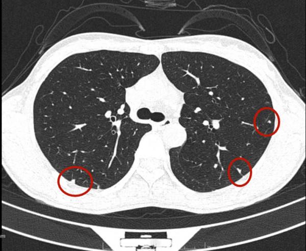 問診分析：兩肺多發實性結節，各科各醫院意見不一，如何是好？