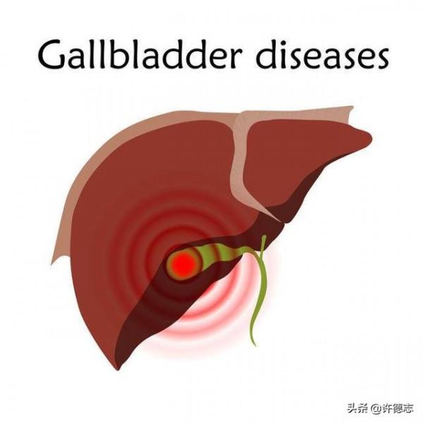 膽囊息肉如何治療 中醫膽囊息肉如何治療