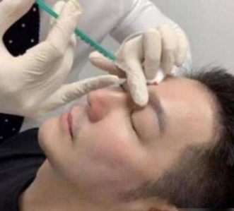 臉腫，嘴歪，笑不出來，整容後的&quot&semi;矽膠臉&quot&semi;把這9位好演員，害慘了