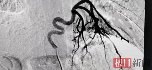 罕見！男子大口咯血，竟是腹部多長了一根血管，還悄悄連上了肺……