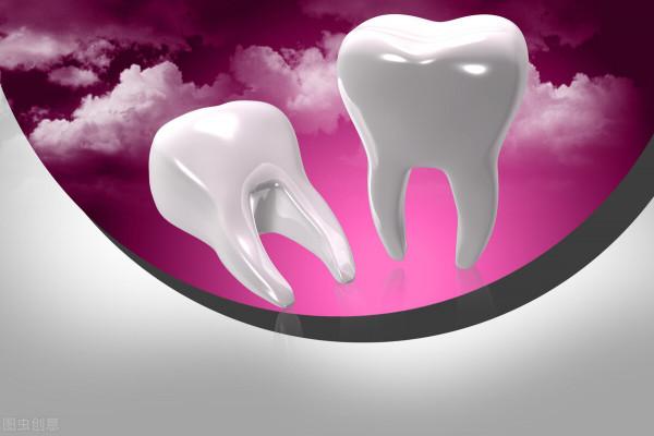 洗牙也分等級,這4個等級避免洗牙被騙 洗牙也分等級,這4個等級避免洗牙被騙