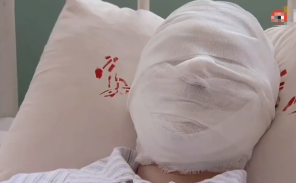 有人熱油澆臉不起泡，有人臉被燙熟創醫療奇蹟，國產劇毀容太離譜