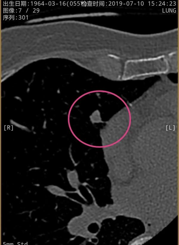 右肺多發實性結節2年多了，我們該怎麼看待？