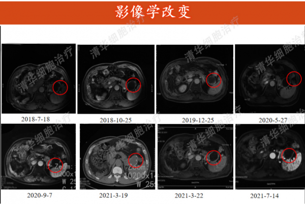 一年內竟查出兩種癌症,被腫瘤青睞的他採用“輔助”治療打破魔咒 一年內竟查出兩種癌症,被腫瘤青睞的他採用“輔助”治療打破魔咒