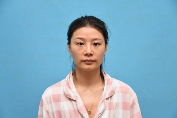 33歲老阿姨做完自體脂肪面部填充60天,閨蜜說我年輕了不止10歲 33歲老阿姨做完自體脂肪面部填充60天,閨蜜說我年輕了不止10歲