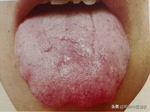 嘔吐虛症，脾胃陽虛的舌象